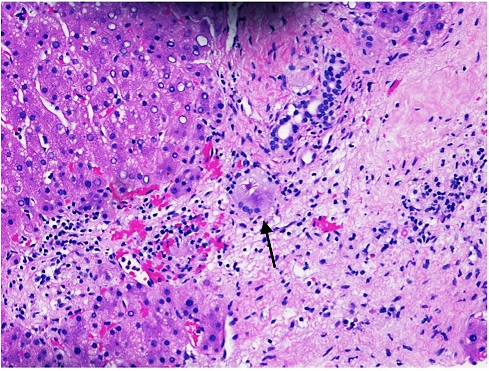 Cureus | Sarcoidosis Manifesting as Liver Granuloma With Asteroid Bodies