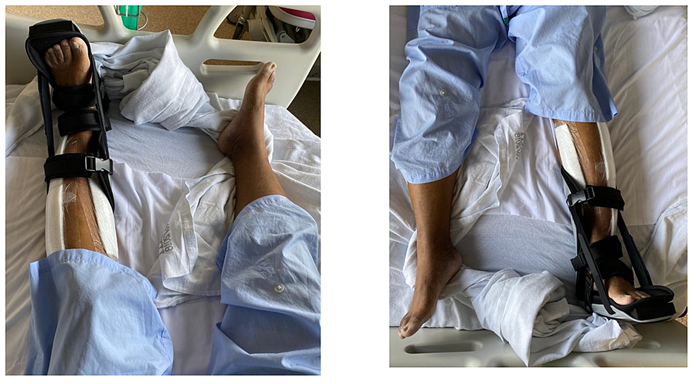Cureus Bilateral Well Leg Compartment Syndrome as a Complication of