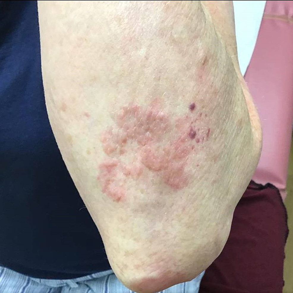 Cureus Treatment of Granuloma Annulare With Pentoxifylline and Oral