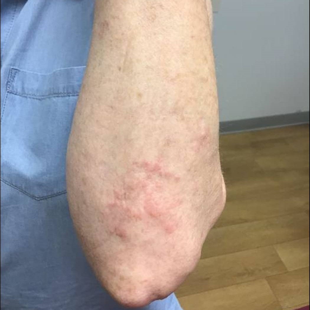 Cureus Treatment of Granuloma Annulare With Pentoxifylline and Oral