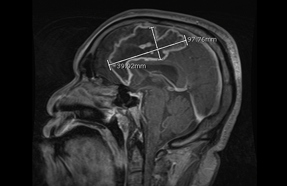 Contrast-enhanced-MRI-showing-a-9.7-x-3.9-x-2.6-cm-(98-cc)-ring-enhancing-lesion-of-the-left-frontal-lobe-in-the-prior-area-of-infarction.-