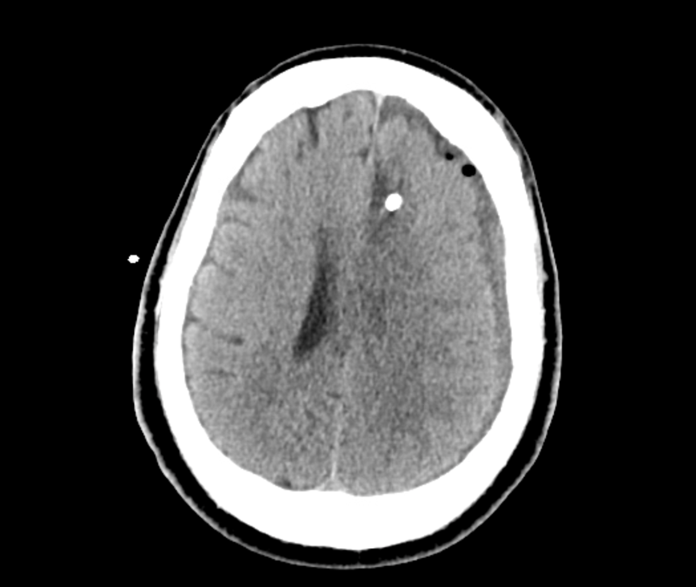 Non-contrast-CT-demonstrating-collapsed-abscess-cavity-and-small-left-frontal-extra-axial-fluid-collection.