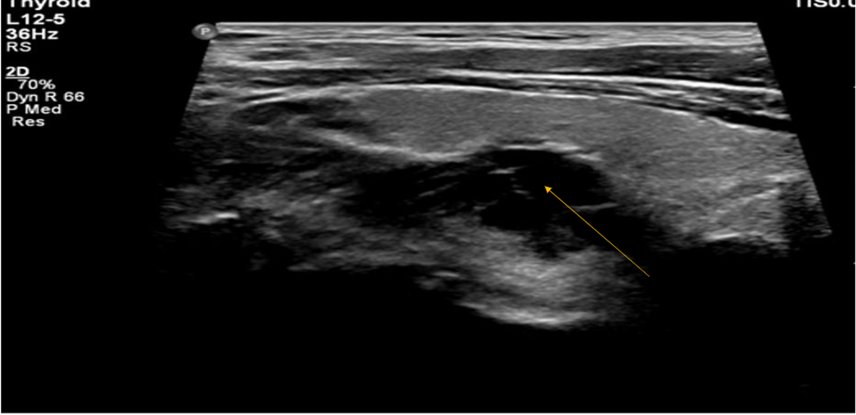 Cureus Primary Hyperparathyroidism Secondary To A Sestamibi Negative Cystic Parathyroid Adenoma 4059