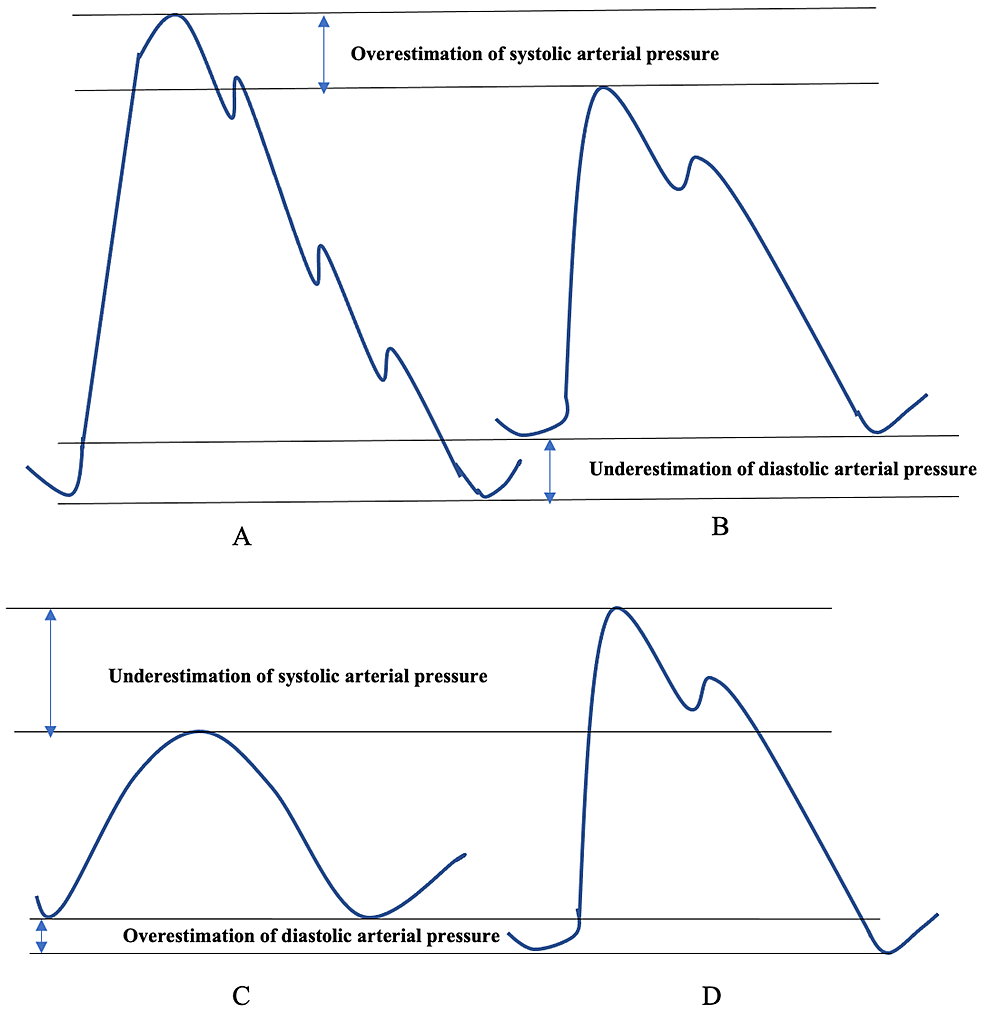 PDF] Strategies to Reduce Pitfalls in Measuring Blood Pressure