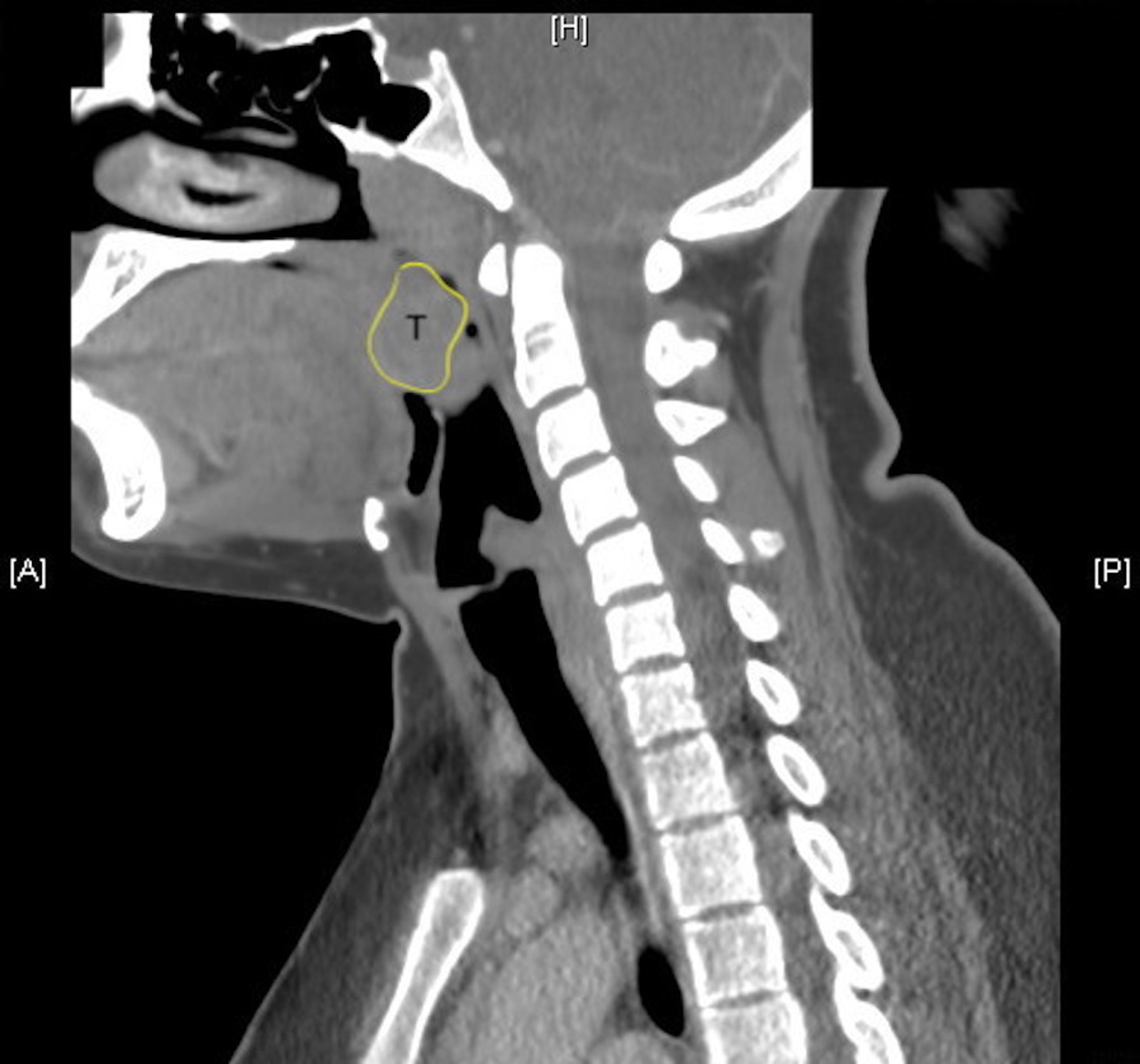 Tonsillar Abscess Treatment