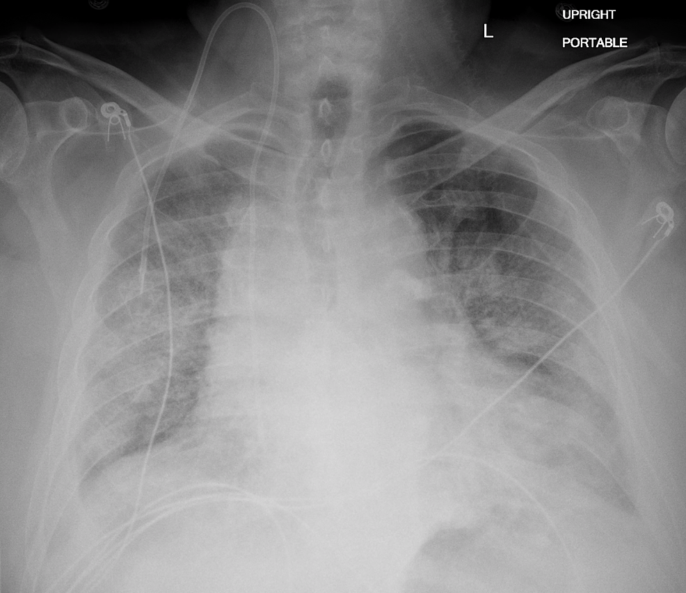 Cureus | Chryseobacterium gleum Causing Healthcare-Associated Pneumonia ...