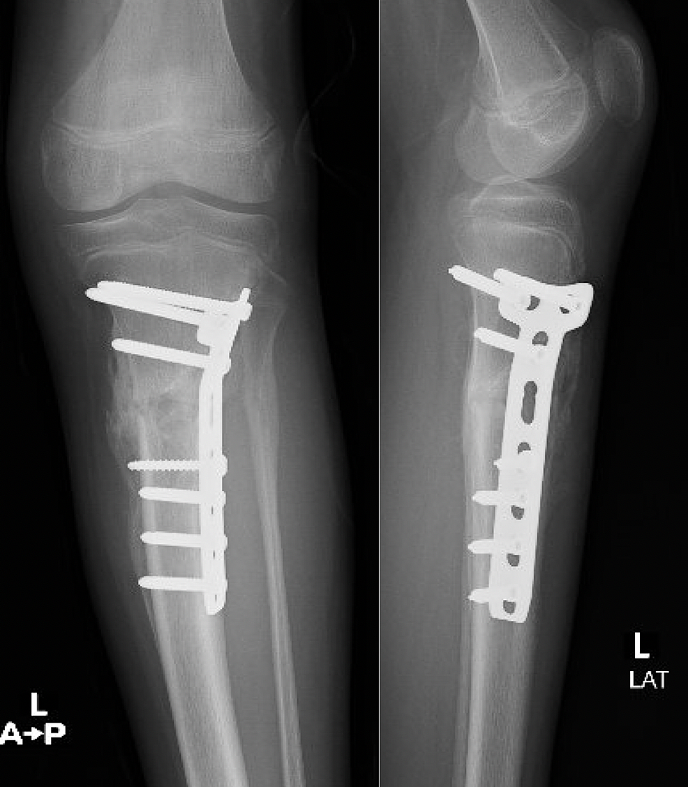 Cureus Nonossifying Fibroma Pathological Fracture in a Patient With