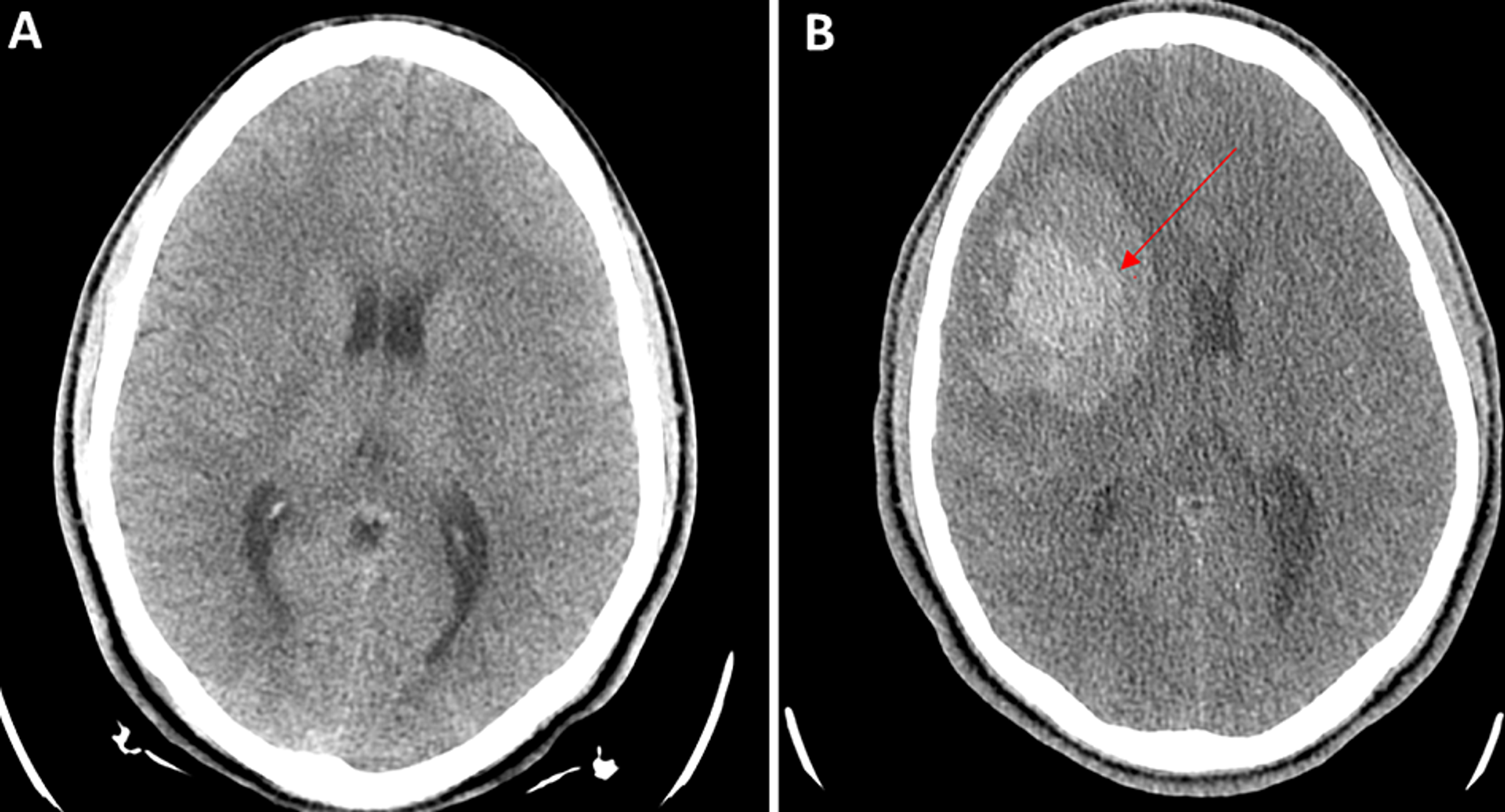 intraparenchymal hemorrhage vs subarachnoid hemorrhage