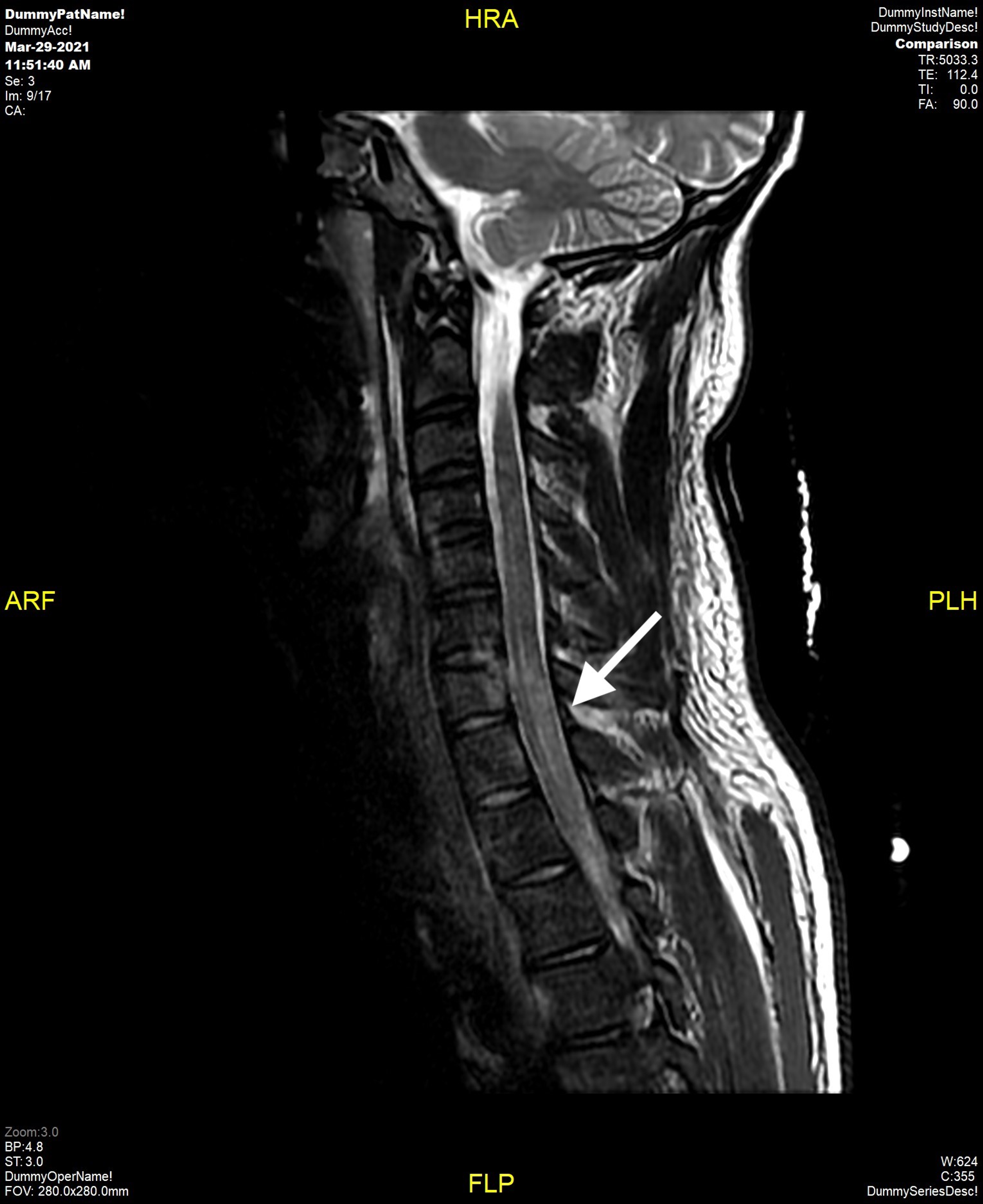 Cureus A Rare Outcome From A Self Inflicted Gunshot Wound To The Neck