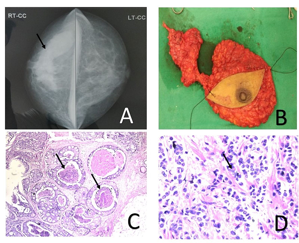 Cureus Synchronous Breast Carcinoma Uterine Myoma and Ovarian