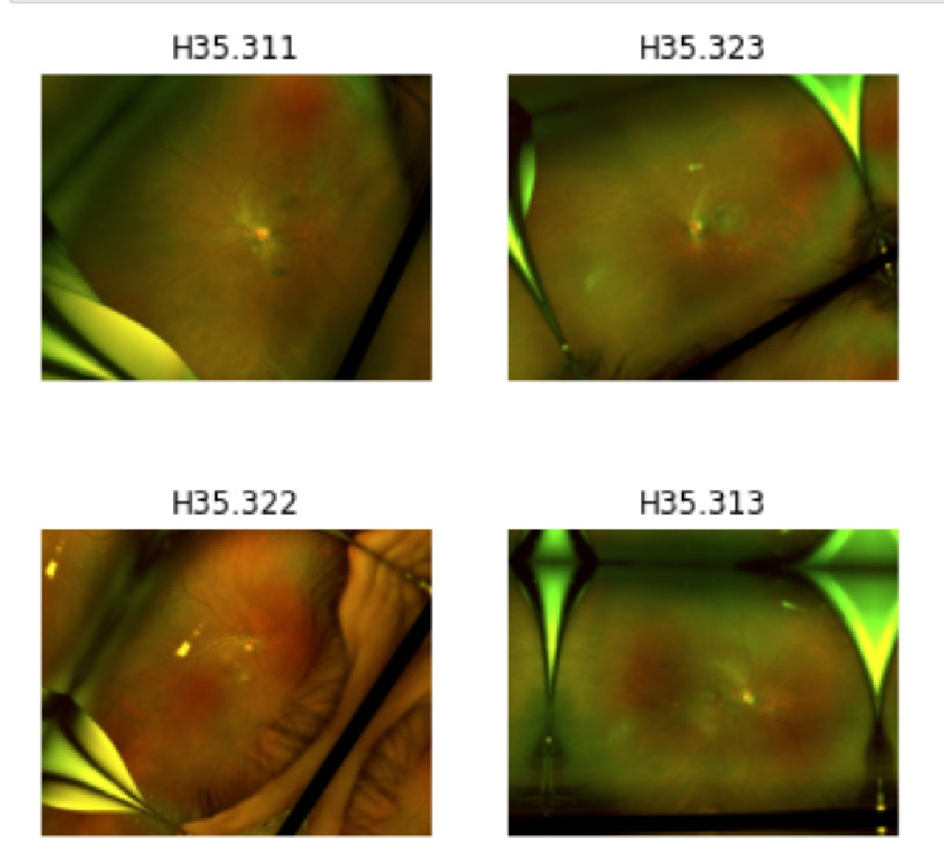 Cureus | Clinical Wide-Field Retinal Image Deep Learning Classification of  Exudative and Non-Exudative Age-Related Macular Degeneration | Article