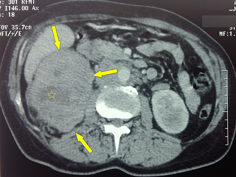 cureus-an-uncommon-case-of-renal-metastasis-from-cervical-cancer