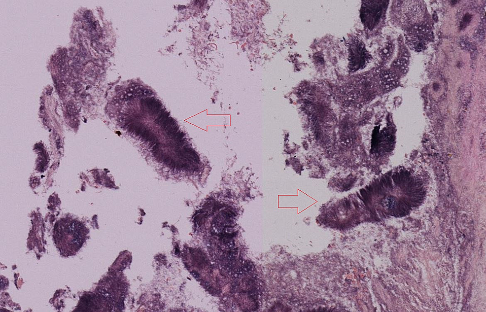 Cureus Actinomyces Infection Mimicking Esophageal Cancer