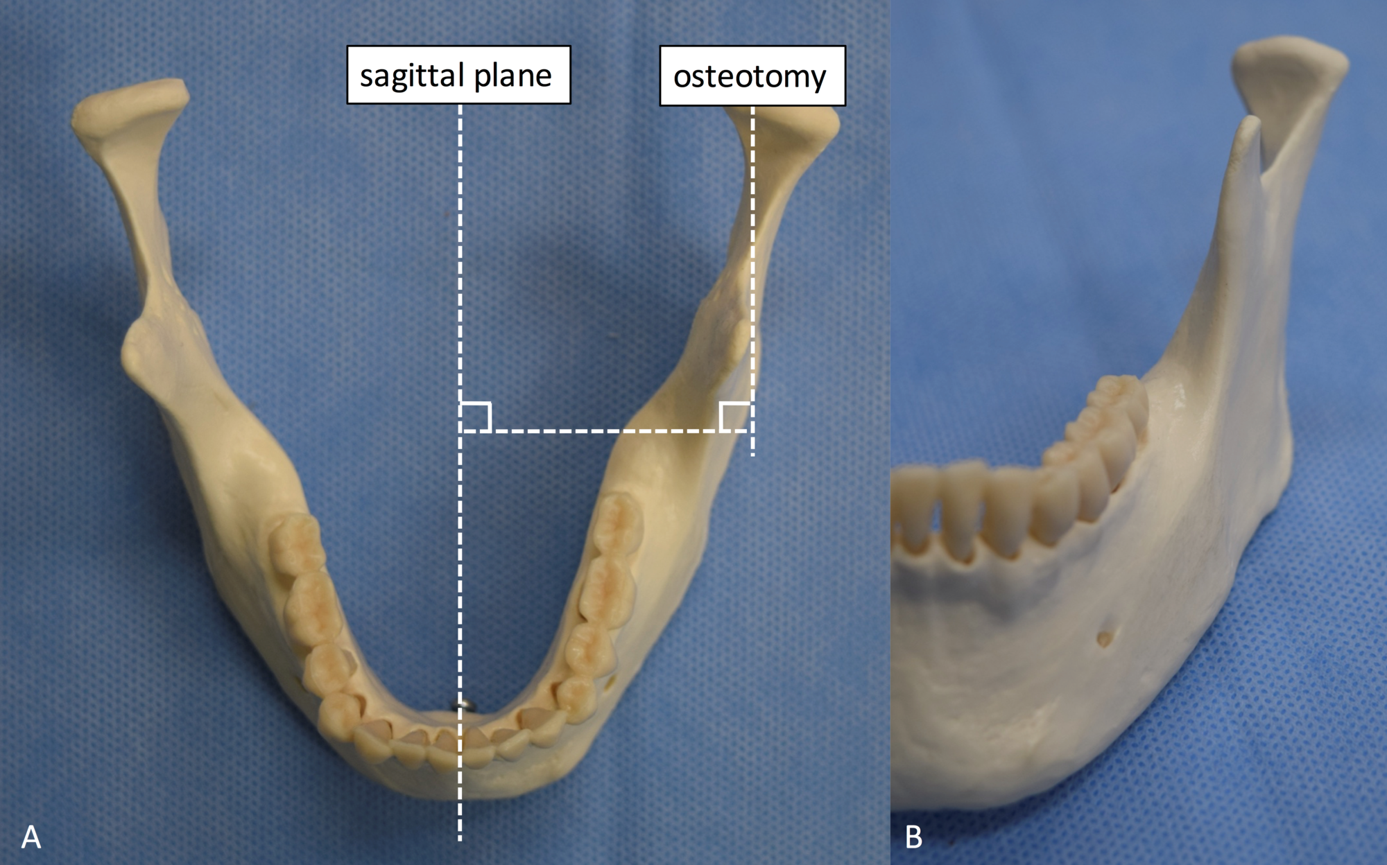 insufficient cleanse steamer Cureus | A Comparative Review of Mandibular Orthognathic Surgeries with a  Focus on Intraoral Vertico-sagittal Ramus Osteotomy