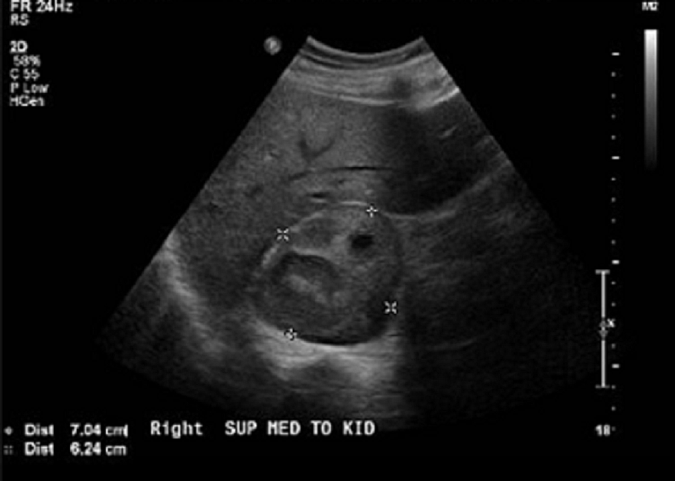Retroperitoneal-ultrasound-showing-7.0-x-6.2-x-7-cm-heterogenic-mass-in-right-adrenal-gland