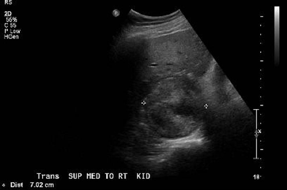 Retroperitoneal-ultrasound-showing-7.0-x-6.2-x-7-cm-heterogenic-mass-in-right-adrenal-gland