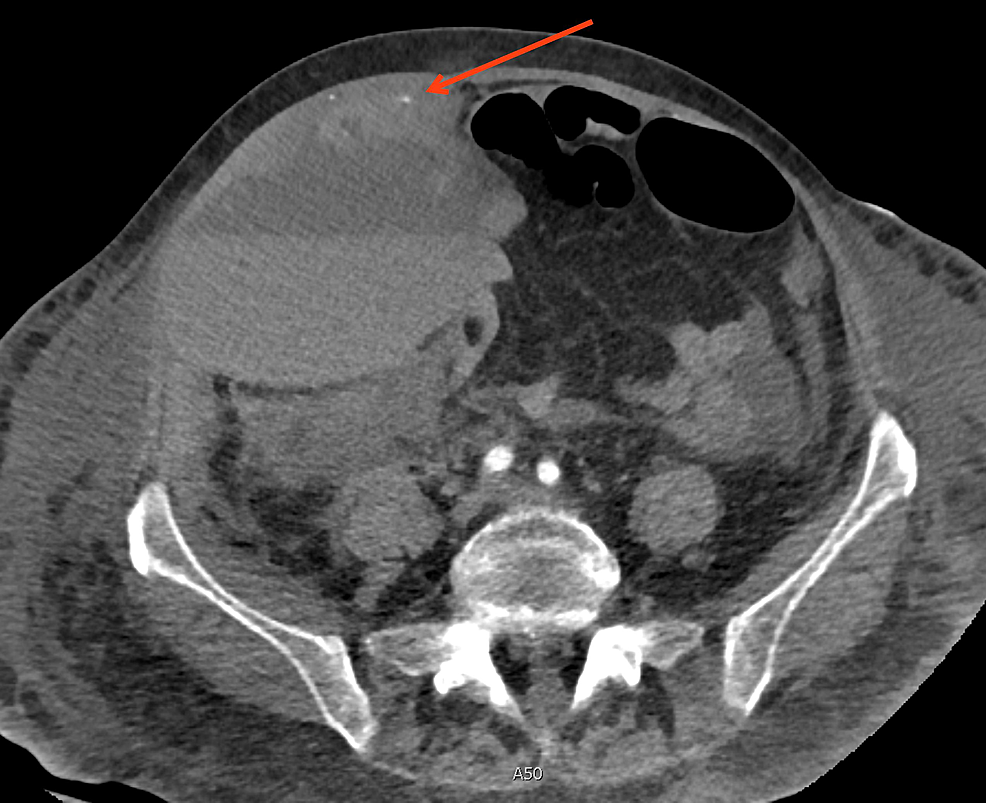 Hematoma In Groin After Hernia Surgery