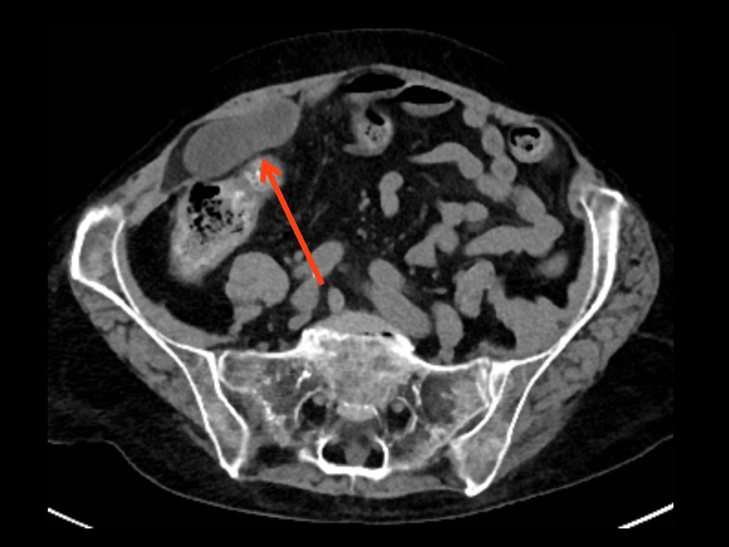 what-is-a-hematoma-after-hernia-surgery-peter-brown-b-vrogue-co