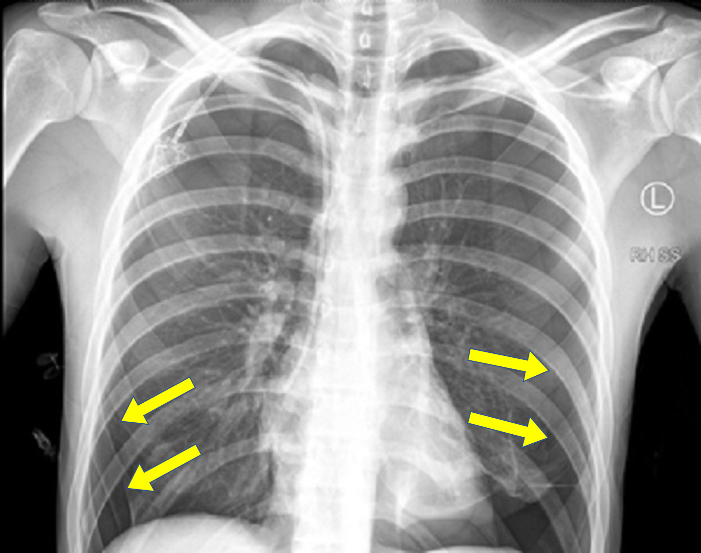 Pneumothorax Chest X Ray Chest X Ray At Presentation - vrogue.co