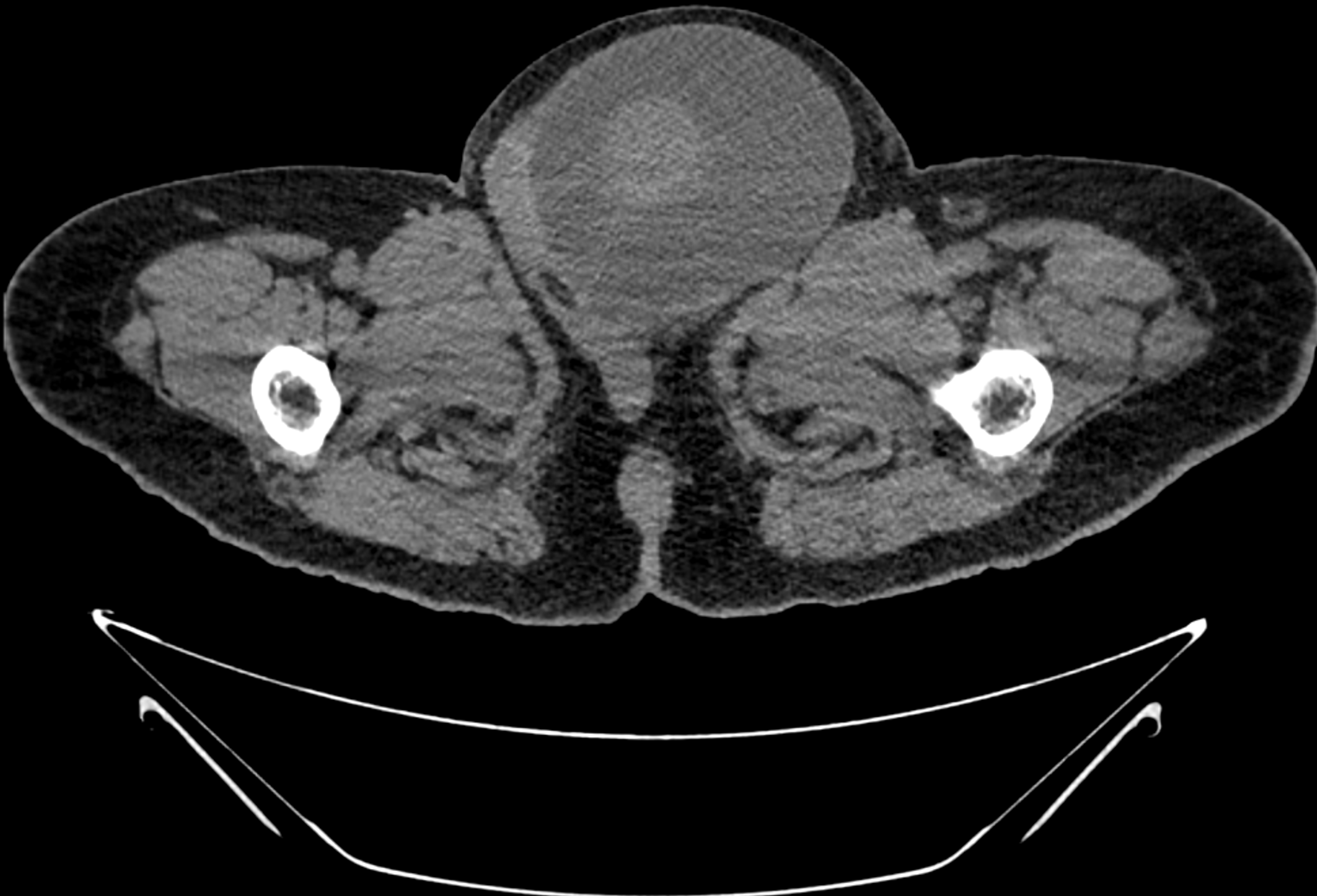 Cureus Giant Abdominoscrotal Hydrocele In Adult A Rare Entity