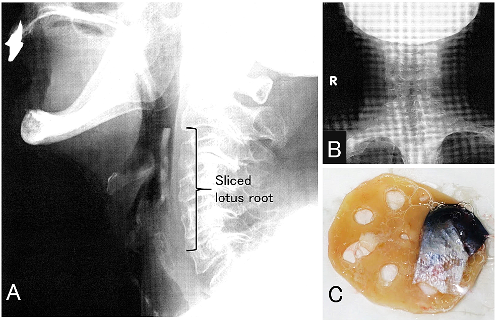 Sliced Lotus Root As A Hypopharyngeal Foreign Body Cureus