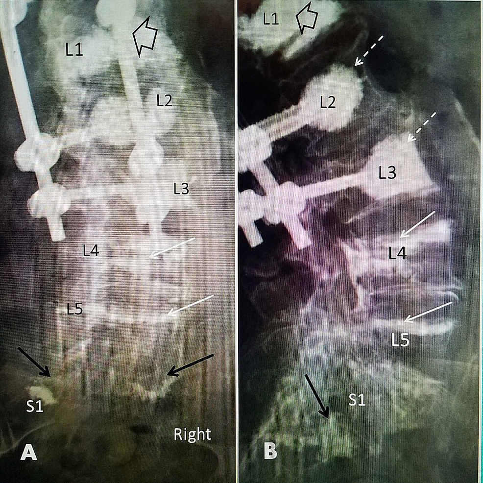 Post-vertebroplasty-films-from-patient-in-Figure-3-(a-78-year-old-female)-who-had-an-L1-fracture-and-kyphoplasty-followed-two-months-later-by-T11-to-L3-instrumentation.-She-went-on-to-develop-progressive-cascading-fractures:-L4,-L5,-and-sacrum