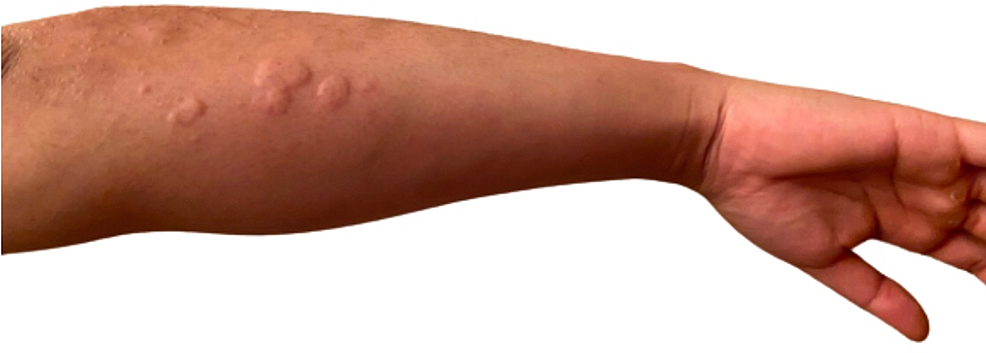Maculopapular-Urticaria-on-Left-Forearm