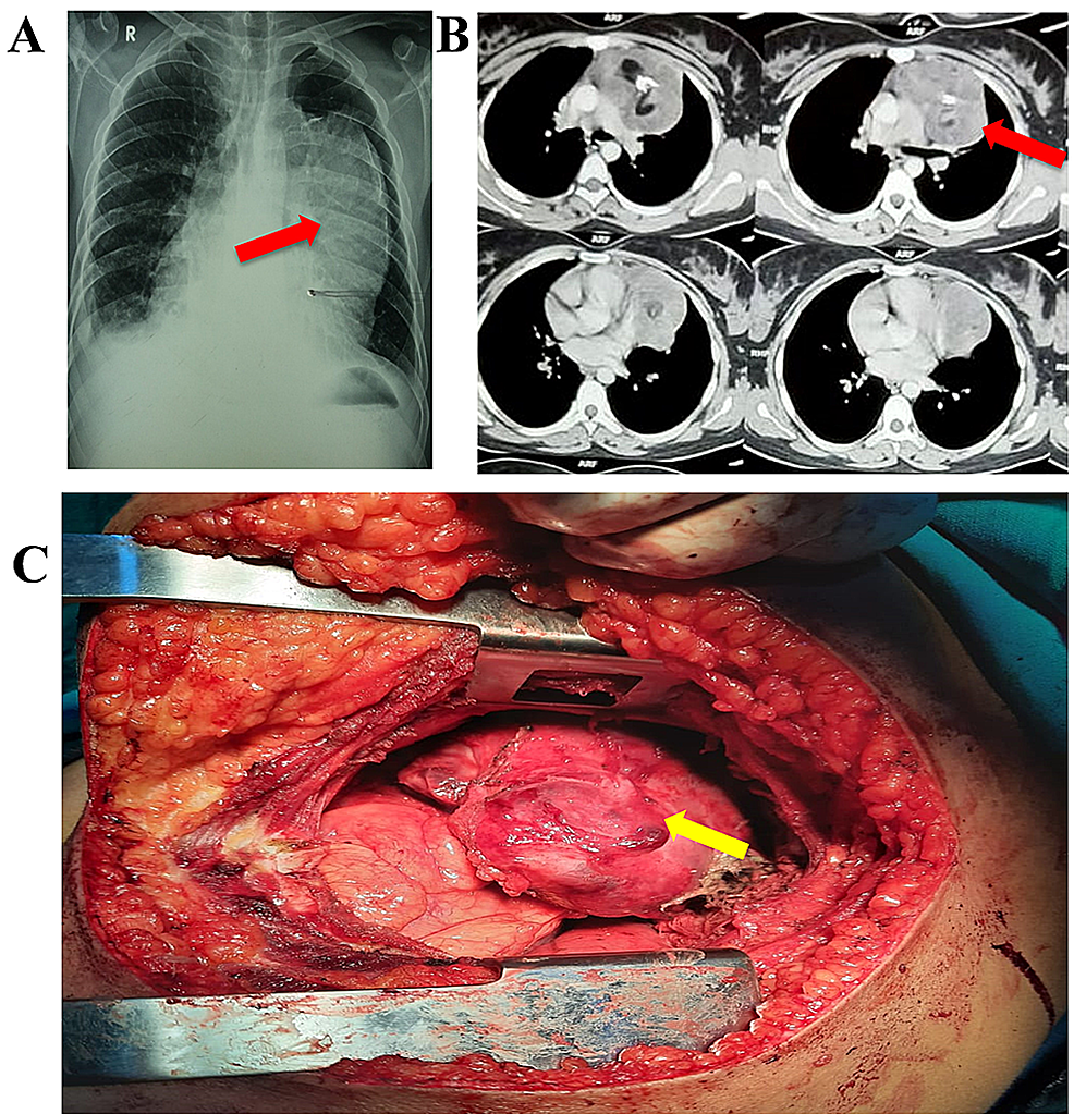 Cureus  Unusual Anterior Mediastinal Tumors Treated at a Tertiary