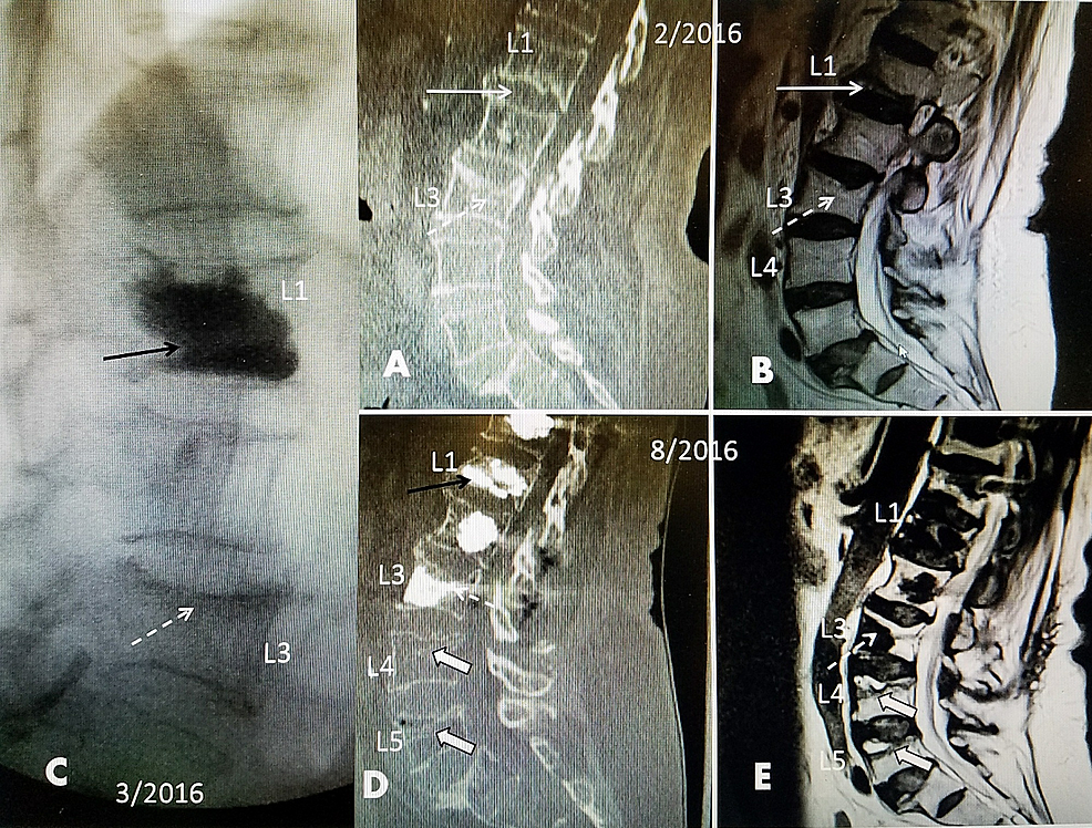 Sequential-radiologic-studies-from-an-L1-fracture-to-cascading-lumbar-and-sacral-fractures-over-six-months