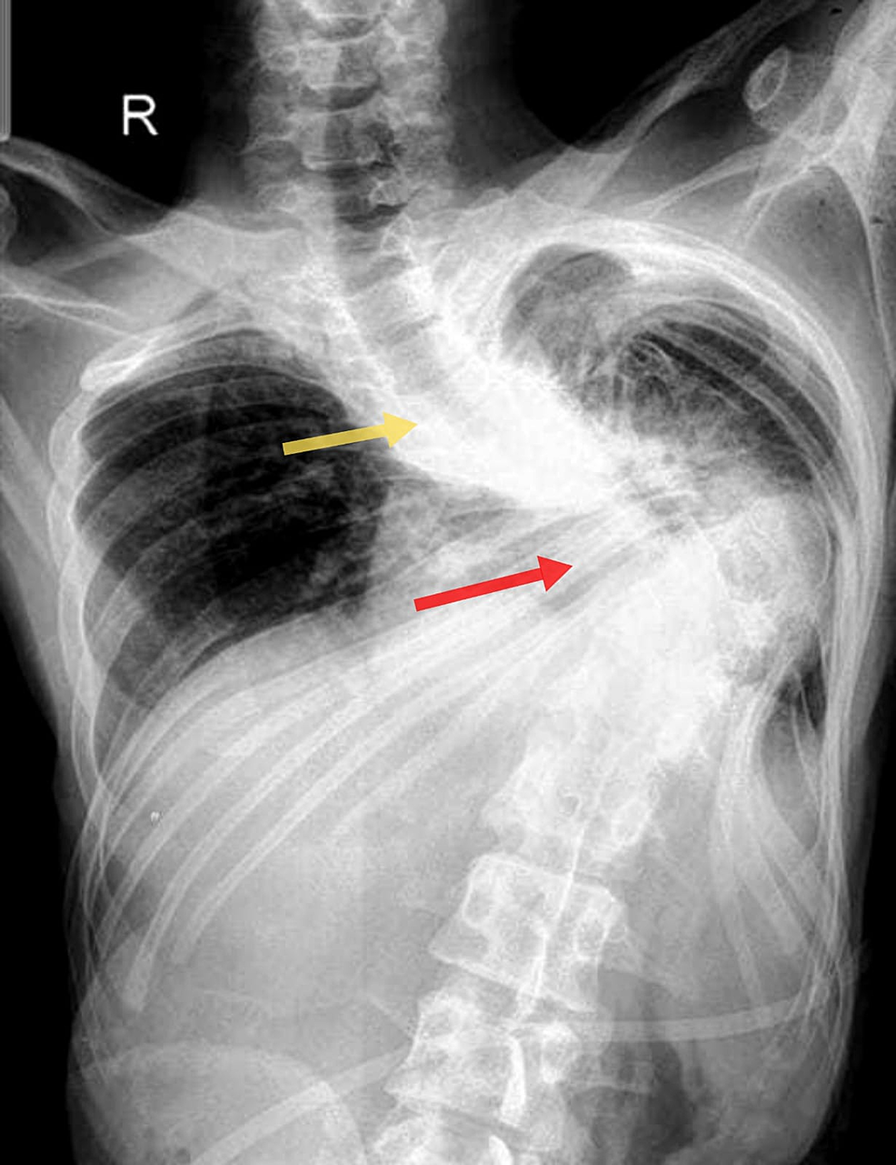 Cureus Challenges in the Endotracheal Intubation of a Patient With