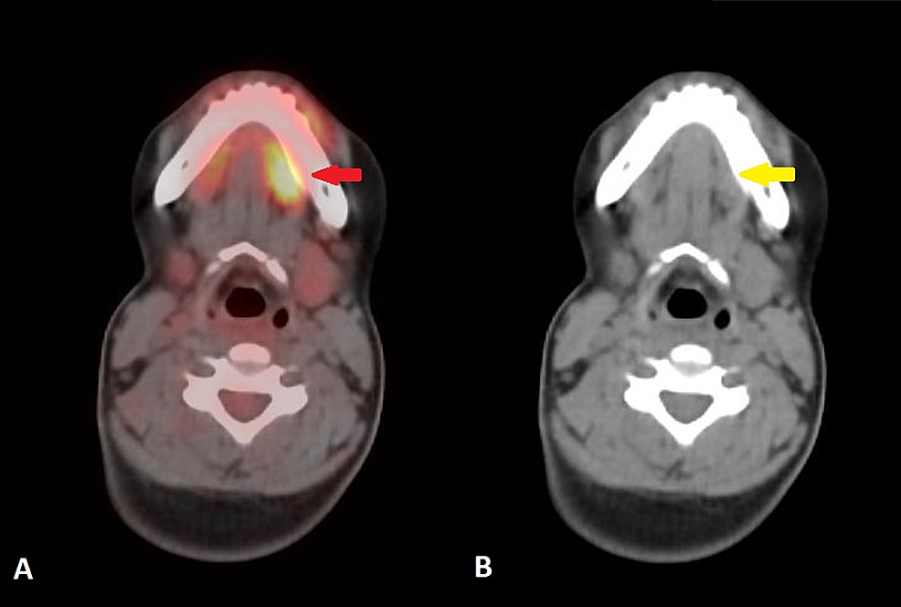 Cureus Incidental Acute Appendicitis On Fluorine 18