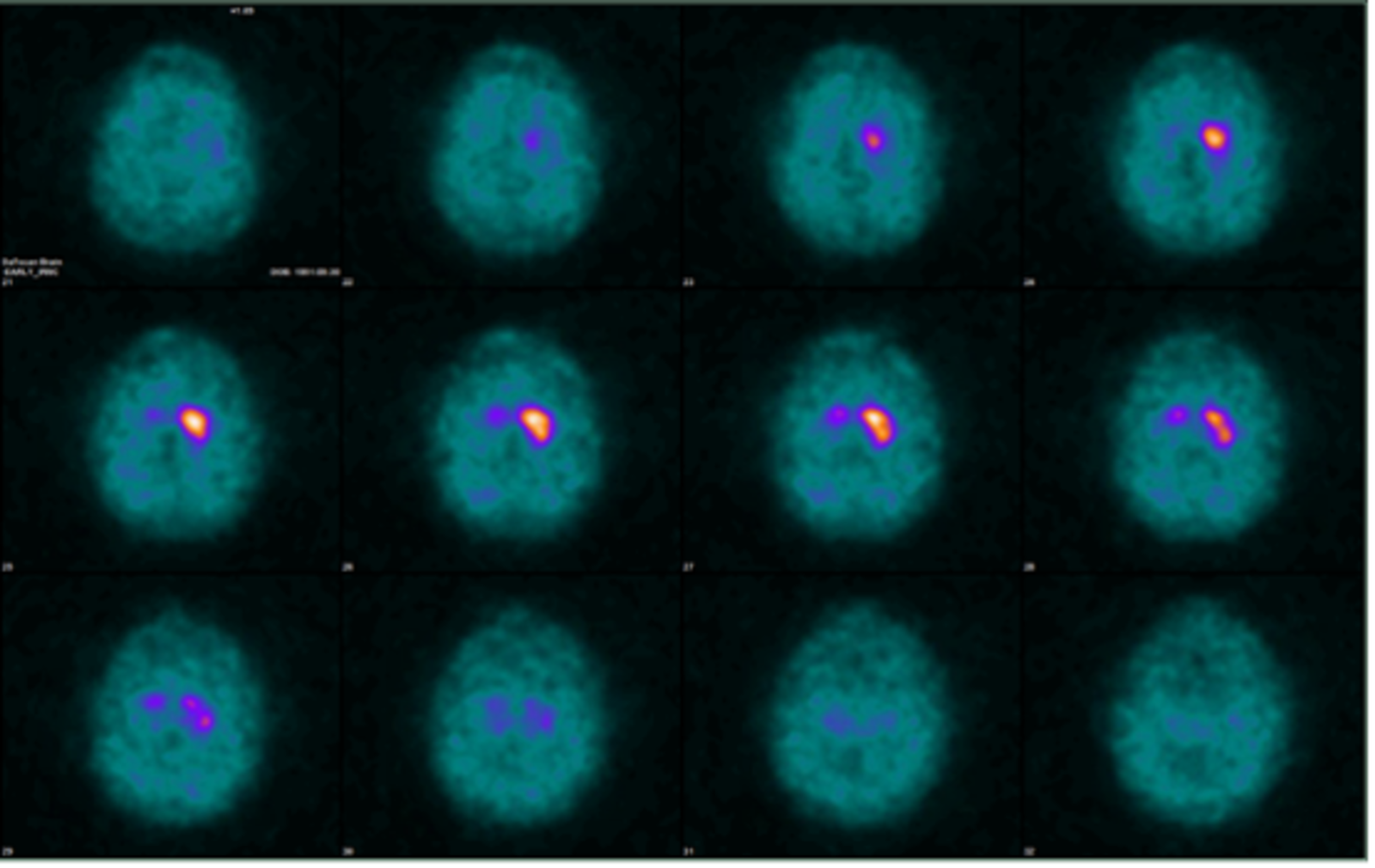 Cureus | Parkinson’s Syndrome After Cranial Radiotherapy: A Case Report