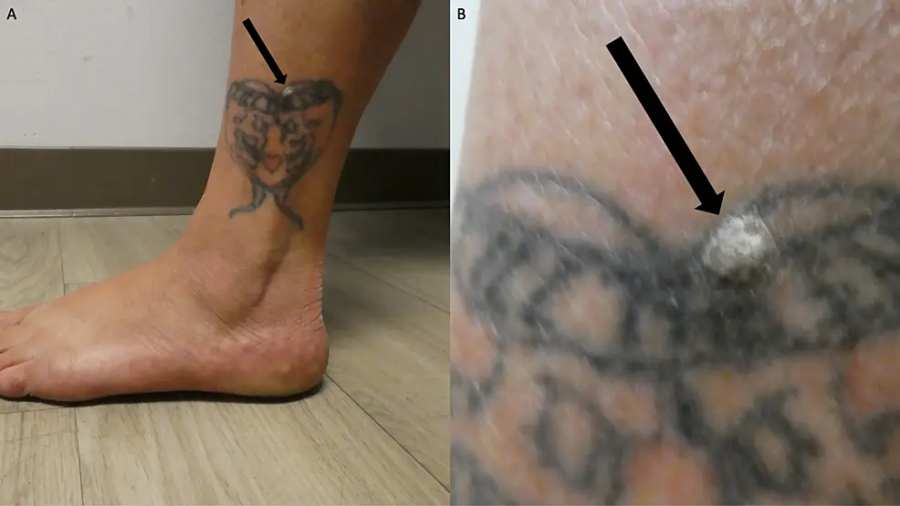 Cureus | Verruca Vulgaris Occurring on a Tattoo: Case Report and Review of  Tattoo-Associated Human Papillomavirus Infections | Article