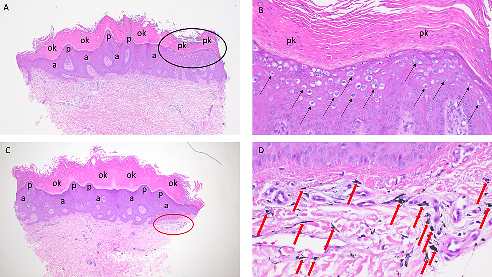 Cureus | Verruca Vulgaris Occurring on a Tattoo: Case Report and Review ...