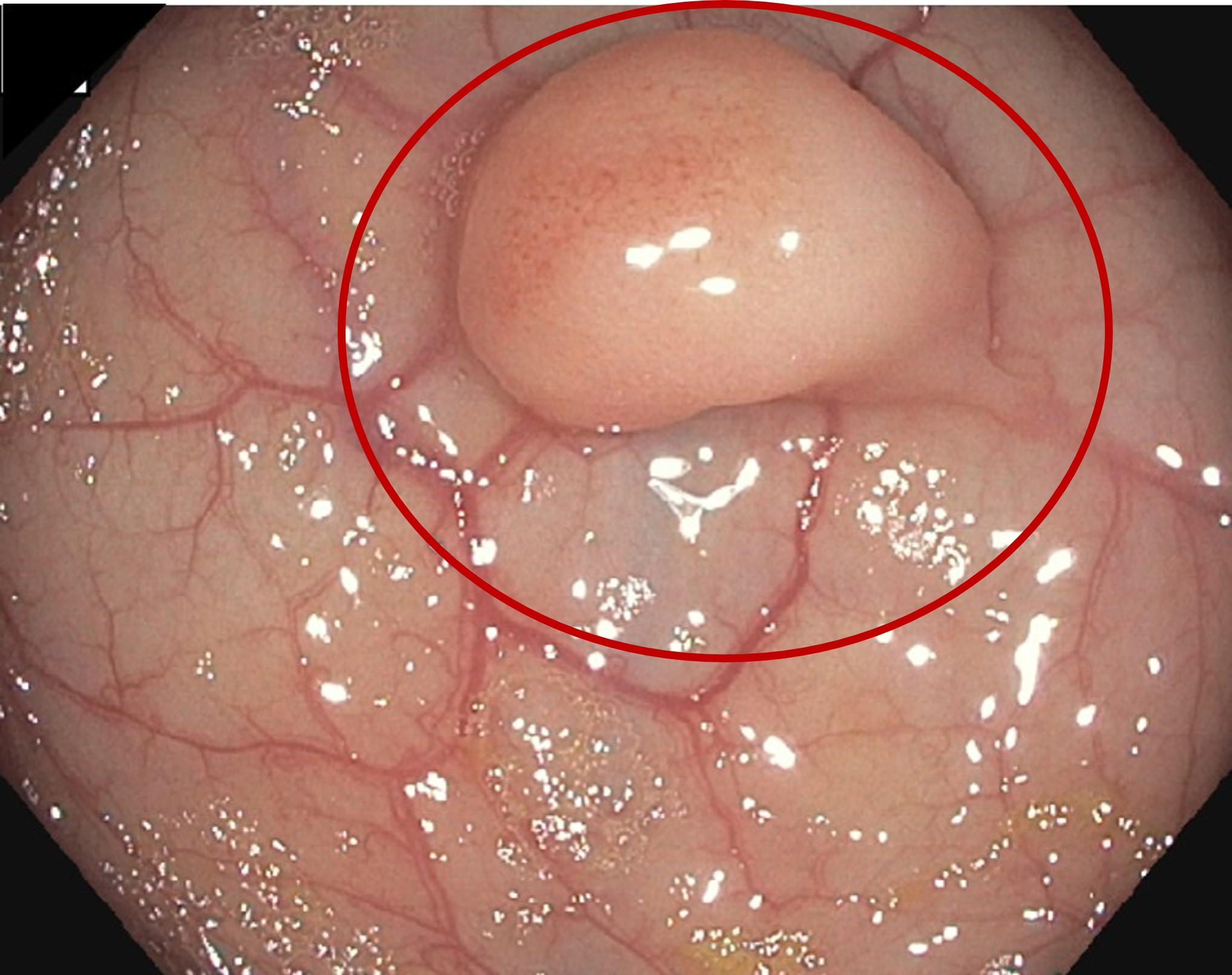 Carcinoma adenoide quístico