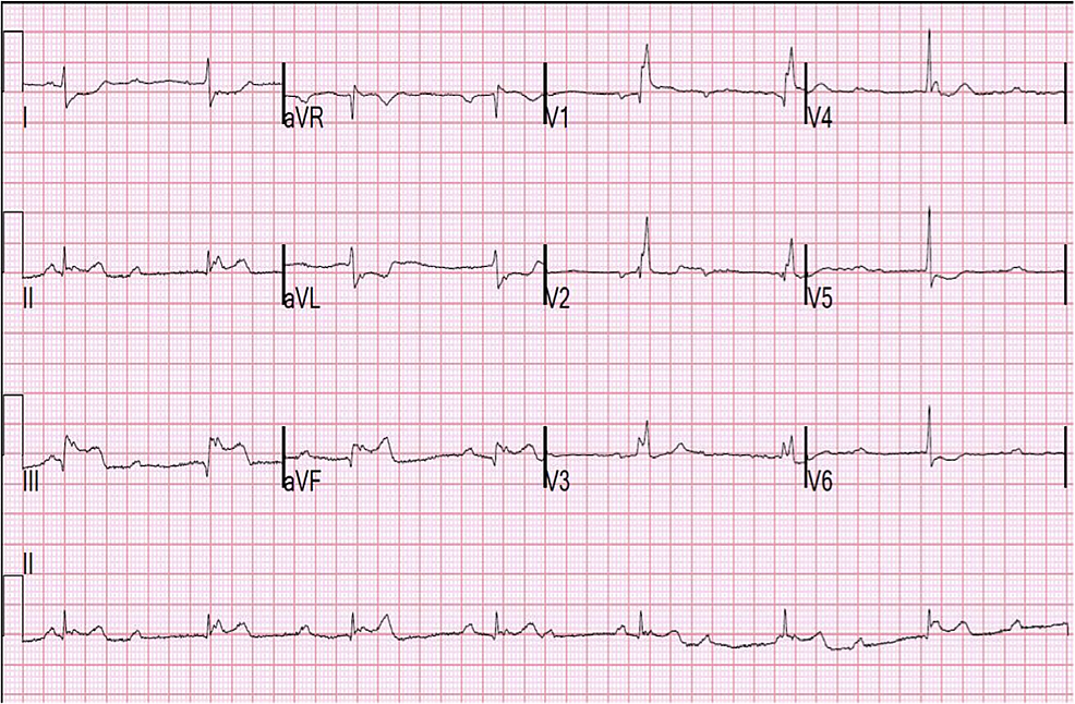 Cureus | A Reversible Cause of Complete Heart Block Causing Chest Pain ...