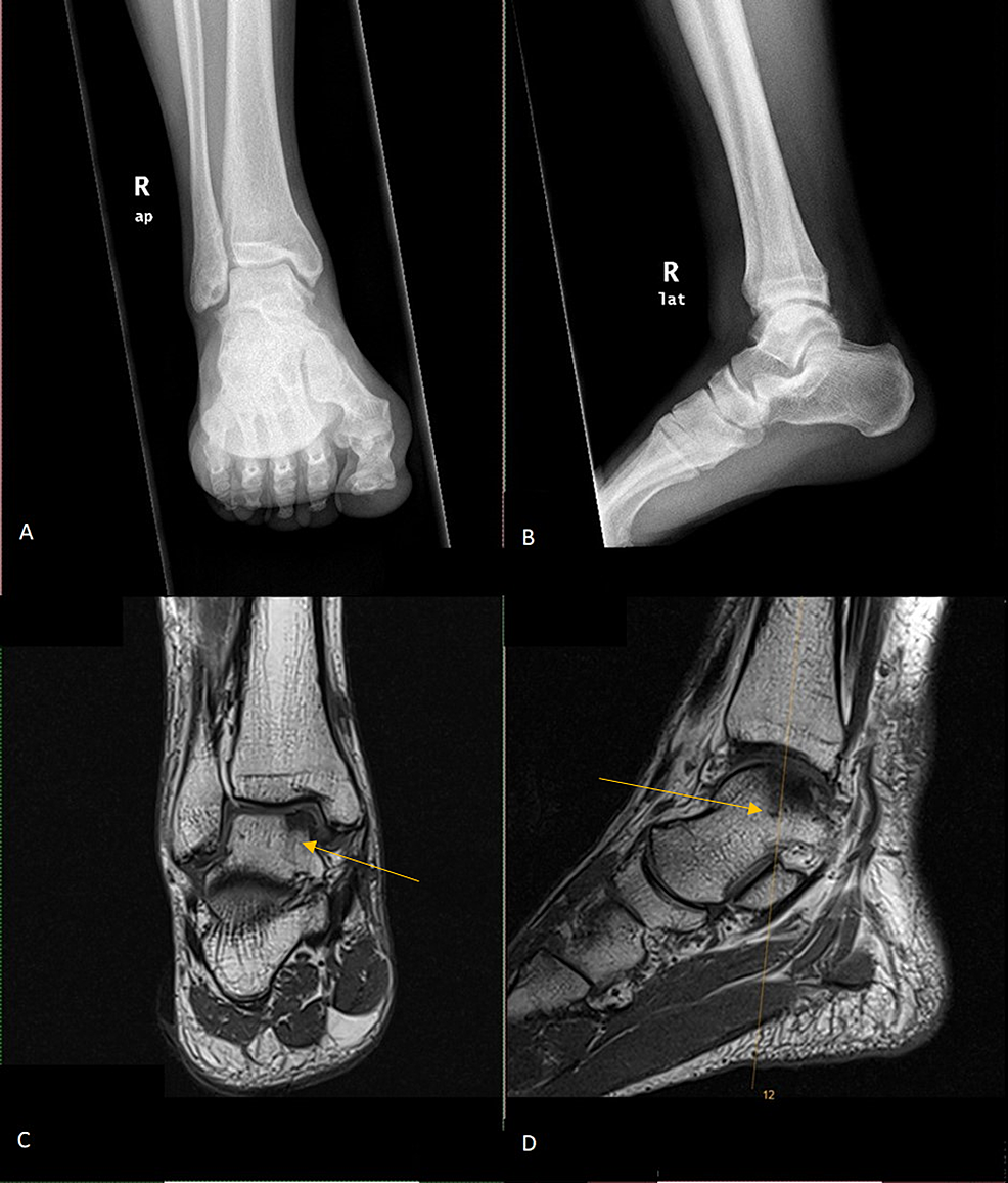 Plain-radiograph-of-AP-(A)-and-lateral-(B)-view-of-right-ankle-show-fracture-fragment-noted-in-the-anterior-ankle-joint.-MRI-of-the-right-ankle-(C,-D)-shows-grade-III-chondromalacia-(arrows)-over-the-medial-side-of-the-talar-surface-with-associated-medial-tibiotalar-joint-space-reduction.