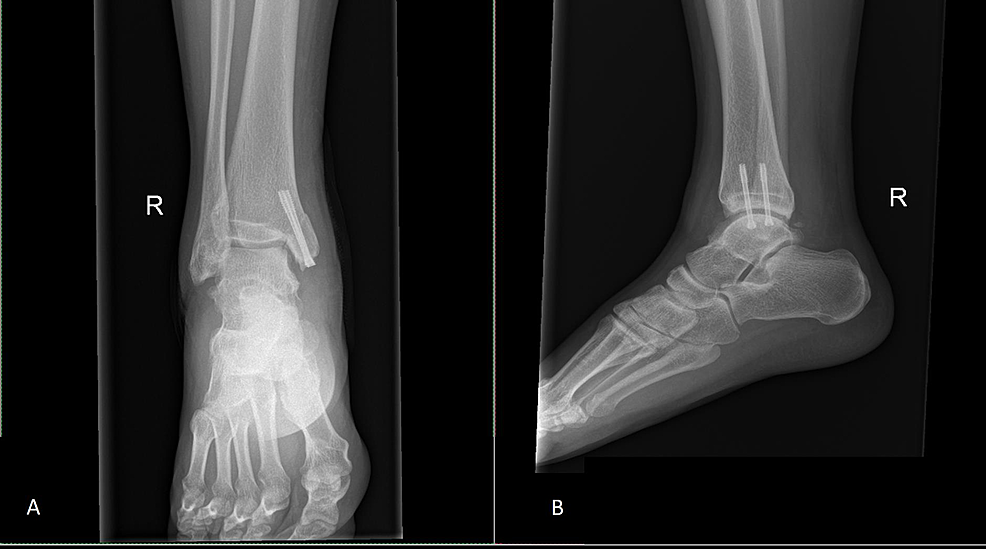 Immediate-post-surgery-plain-radiograph-of-AP-(A)-and-lateral-(B)-view-of-the-right-ankle-show-screw-fixation-of-the-medial-malleolus.