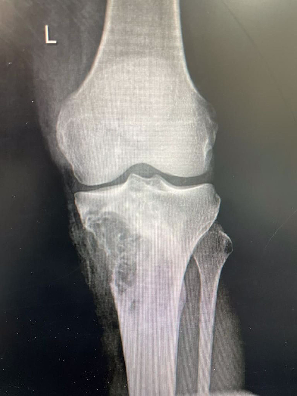 Cureus, Congenital Pseudoarthrosis of Tibia With Anterolateral Bowing  Treated With Ilizarov Ring Fixator: A Case Report