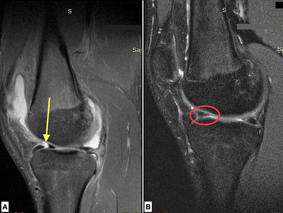 Clinical And Radiological Outcomes After Isolated Anterior Horn Repair 