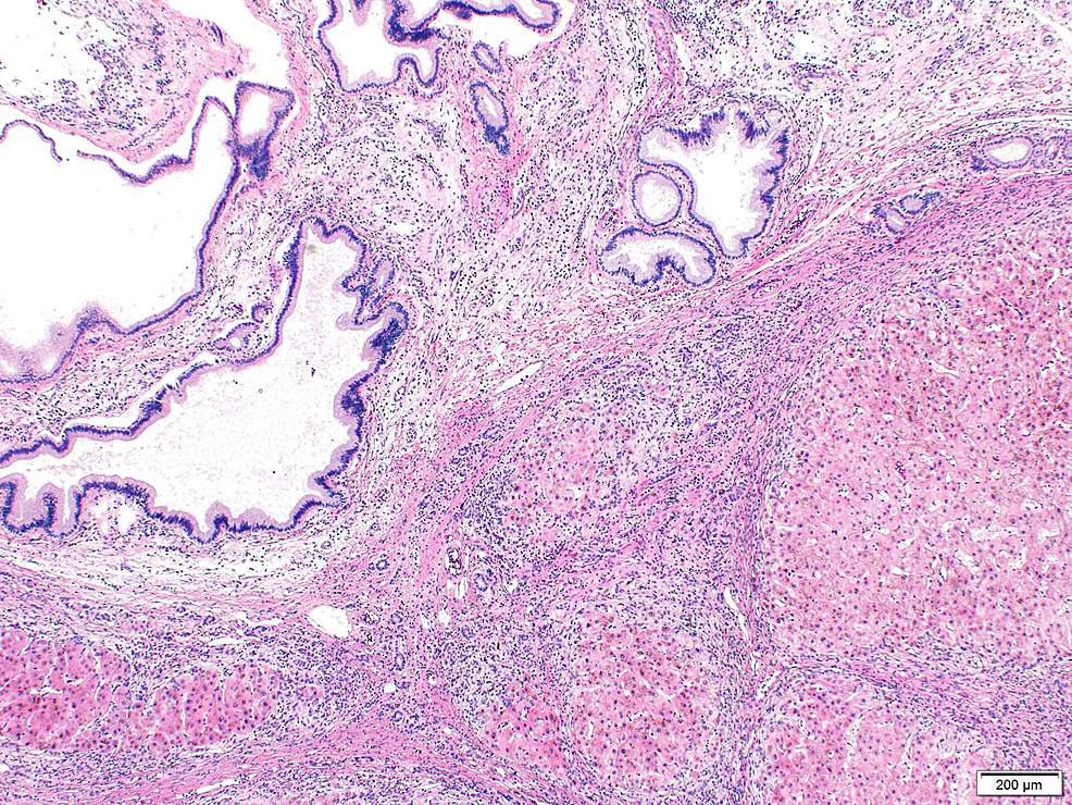 Peribiliary Cysts Mimicking Primary Sclerosing Cholangitis And ...