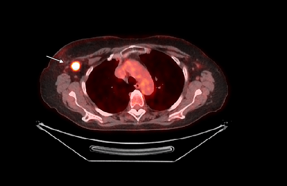 Salvage Hypofractionated Radiotherapy in a Progressive Radiation ...