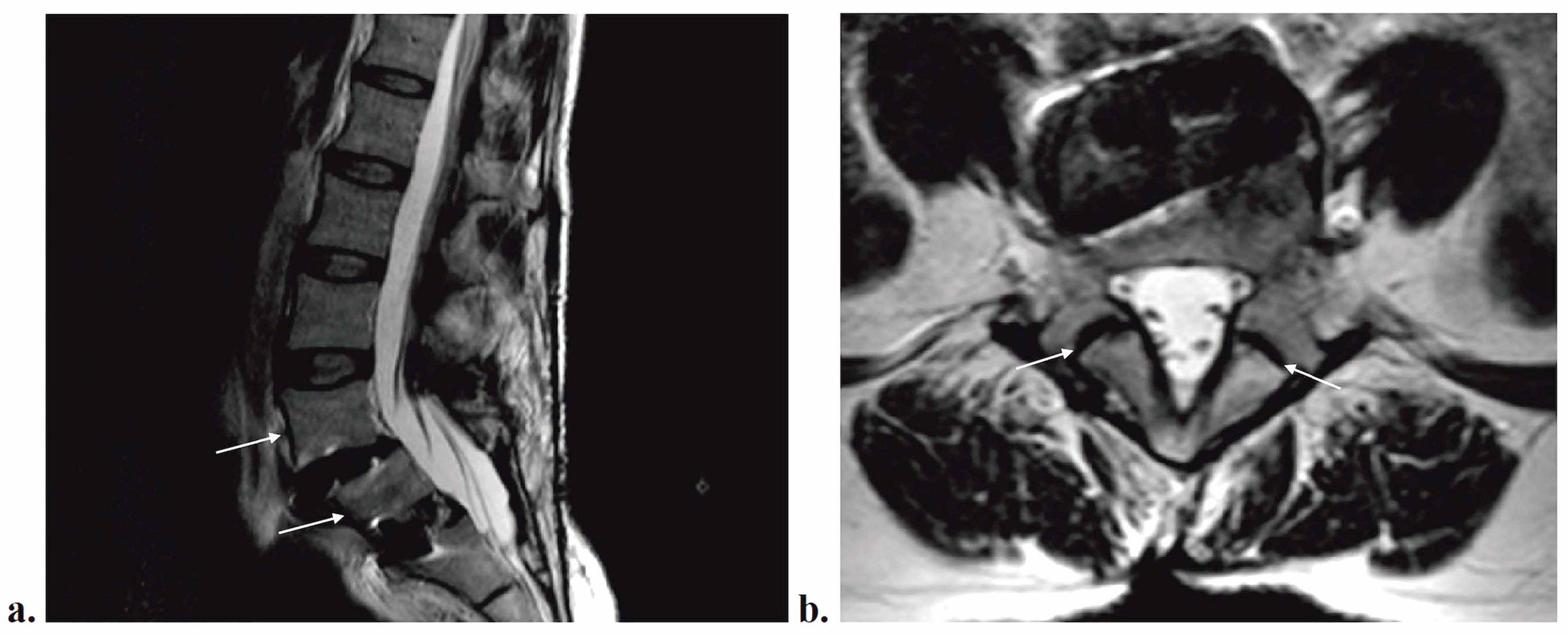 Cureus | Brain Herniation Secondary To Cerebrospinal Fluid Leak Following  Elective Lumbar Spine Surgery