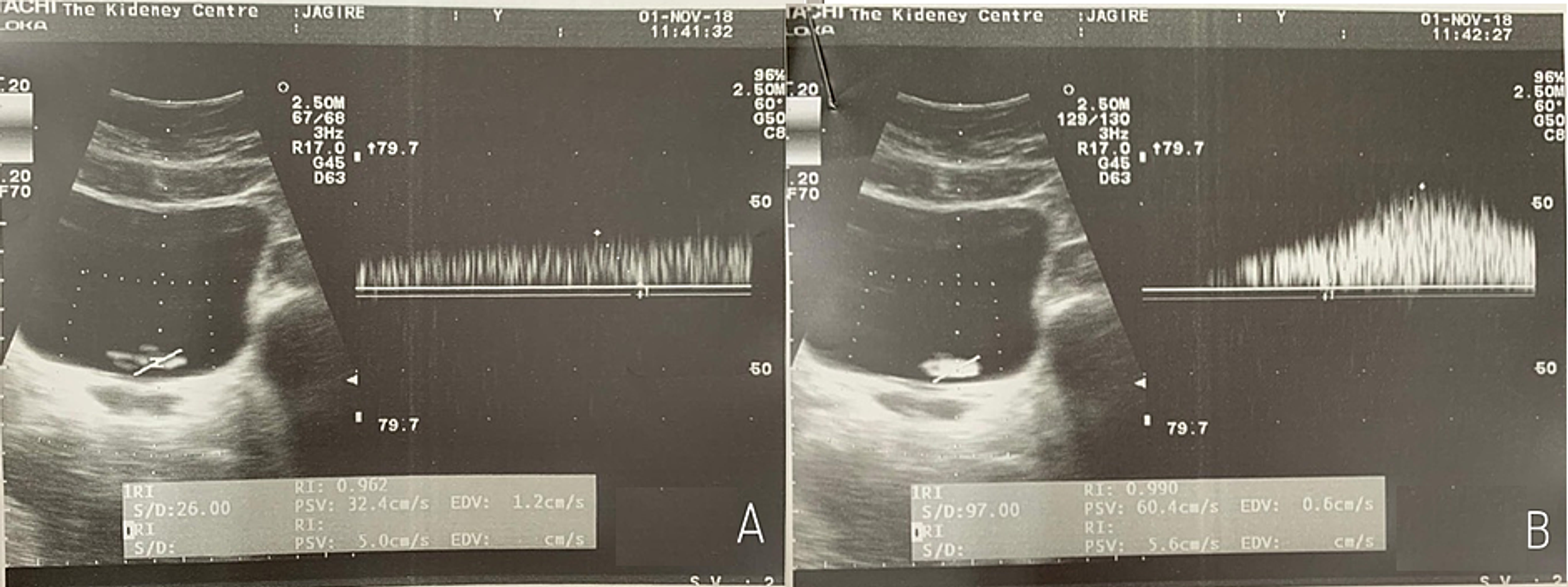 Cureus Doppler Assessed Ureteric Jet Frequency A Valuable Predictor Of Ureteric Obstruction