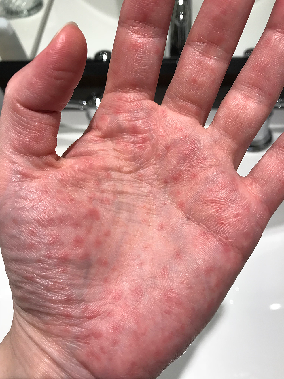 lupus pernio hands