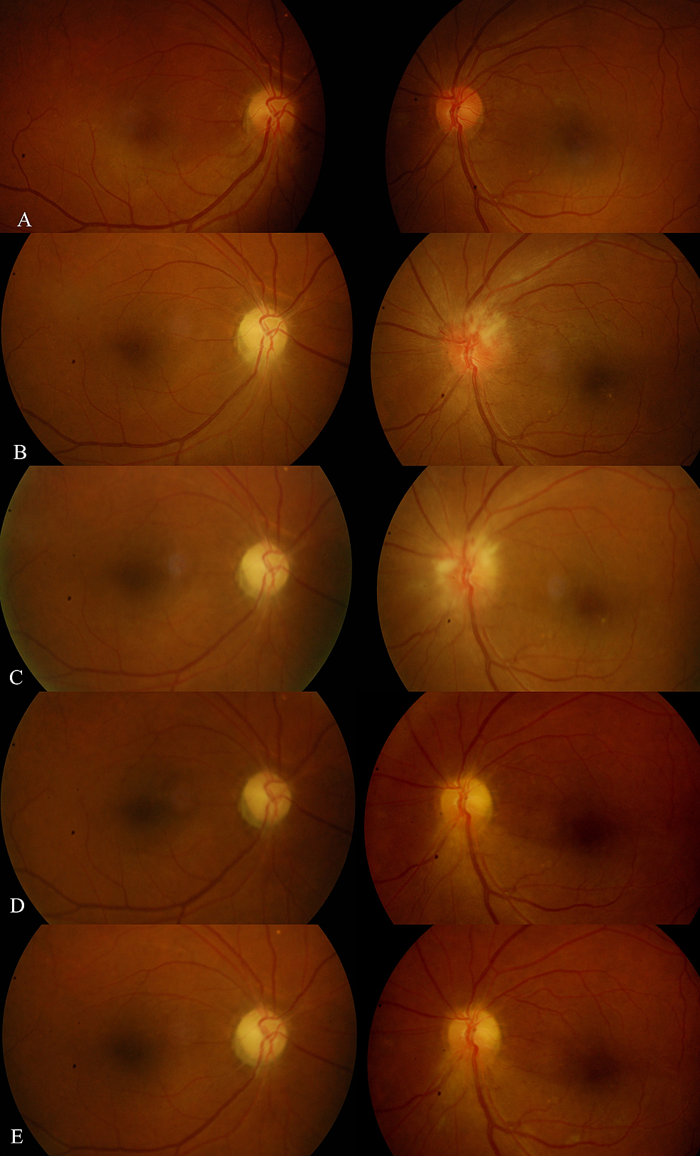 cureus-bilateral-sequential-non-arteritic-anterior-ischemic-optic