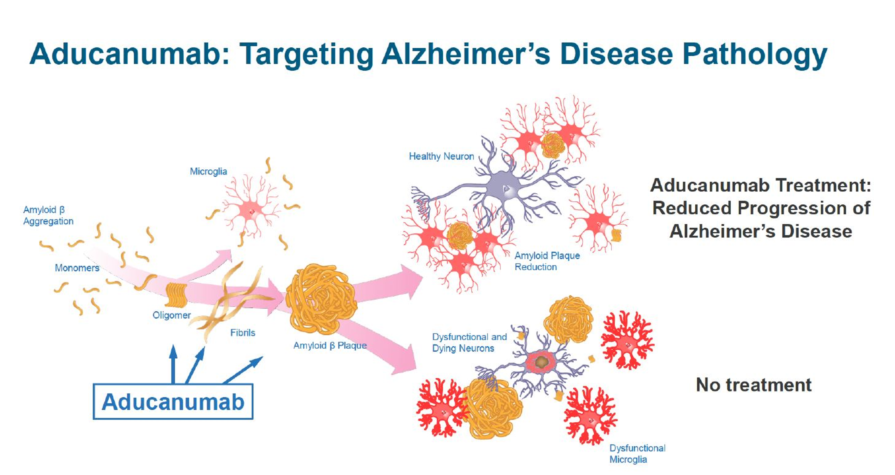 Cureus | Aducanumab as a Novel Treatment for Alzheimer's Disease: A Decade  of Hope, Controversies, and the Future