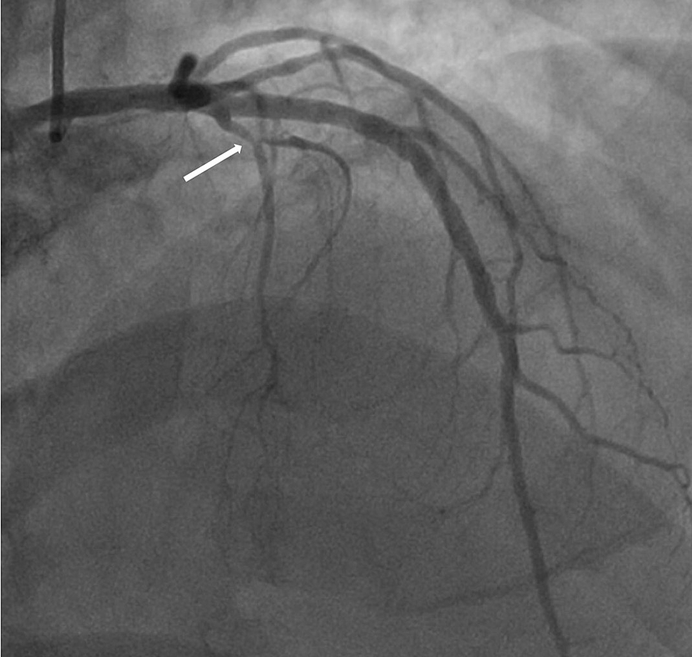 Invasive-coronary-angiography-in-the-right-anterior-oblique-(RAO)-projection-showing-non-obstructive-coronary-artery-disease-in-the-first-septal-perforator-branch-(arrow).-