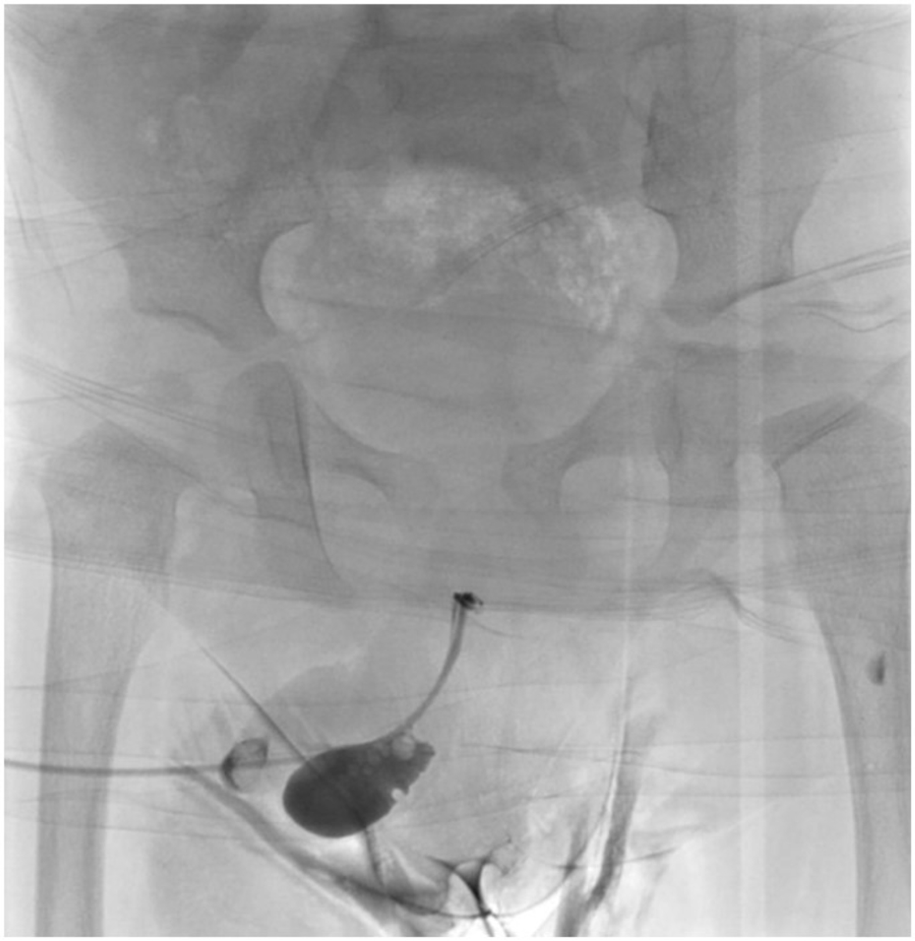 Cureus A Large Congenital Anterior Urethral Diverticulum in a 14