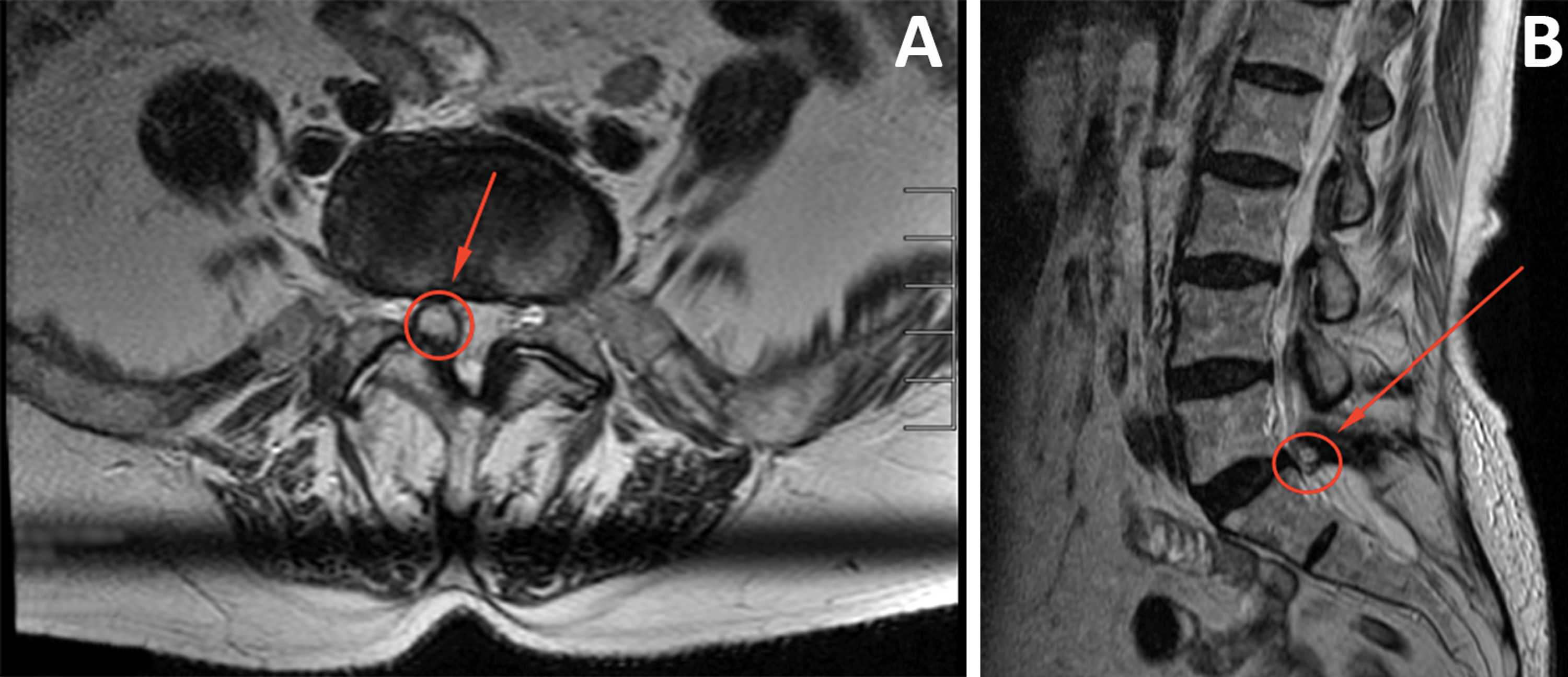 Figure 1 From Lumbar Facet Joint Cyst Treated With De vrogue.co
